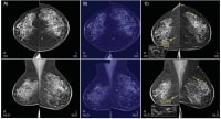 Kunstig intelligens finder nu kræftknuden i nordjyske kvinders bryster, og det letter hospitalernes ressourcemangel